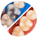 medailon_esteticke-fotokompozitni-vyplne